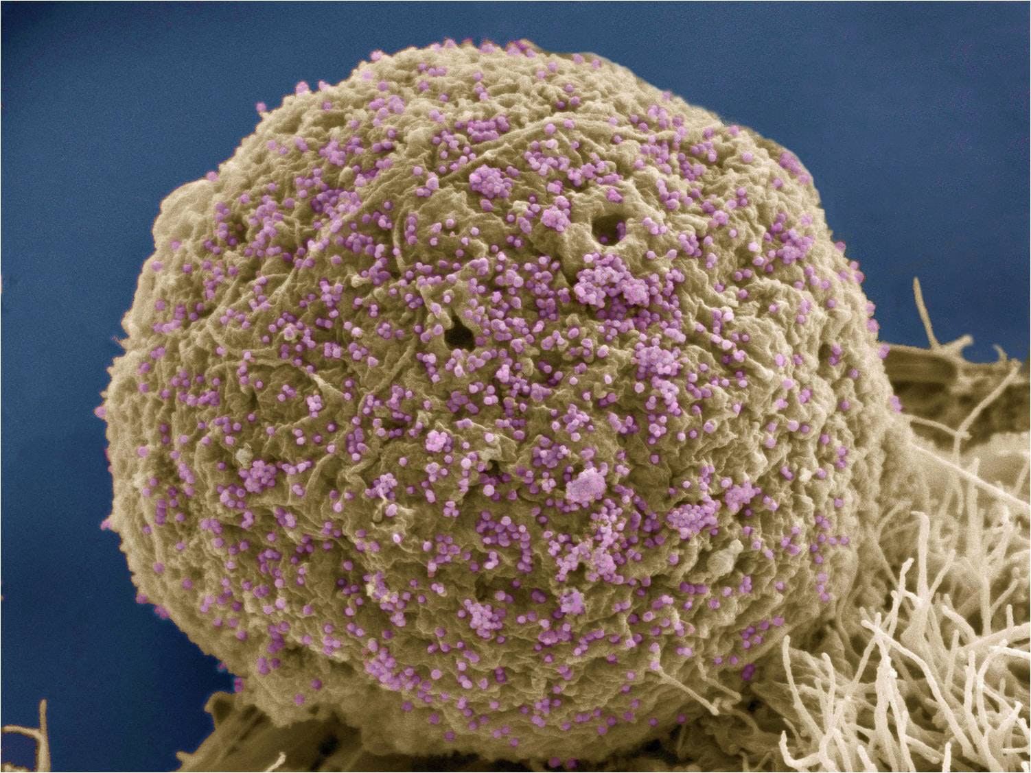 A cure for HIV? Feasible but not yet realized