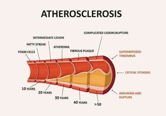 Alzheimer's Disease Is Not Linked To Type 2 Diabetes Or High Blood Pressure