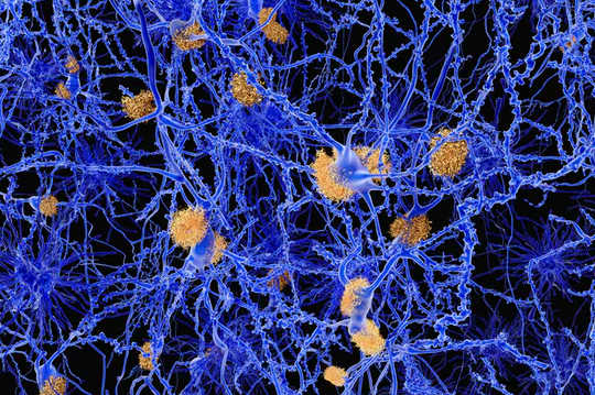 A computer illustration of amyloid plaques among neurons. Amyloid plaques are characteristic features of Alzheimer’s disease.