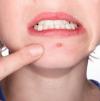 What are the Causes of Acne?