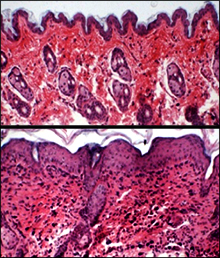 Protein Linked to Atopic Dermatitis